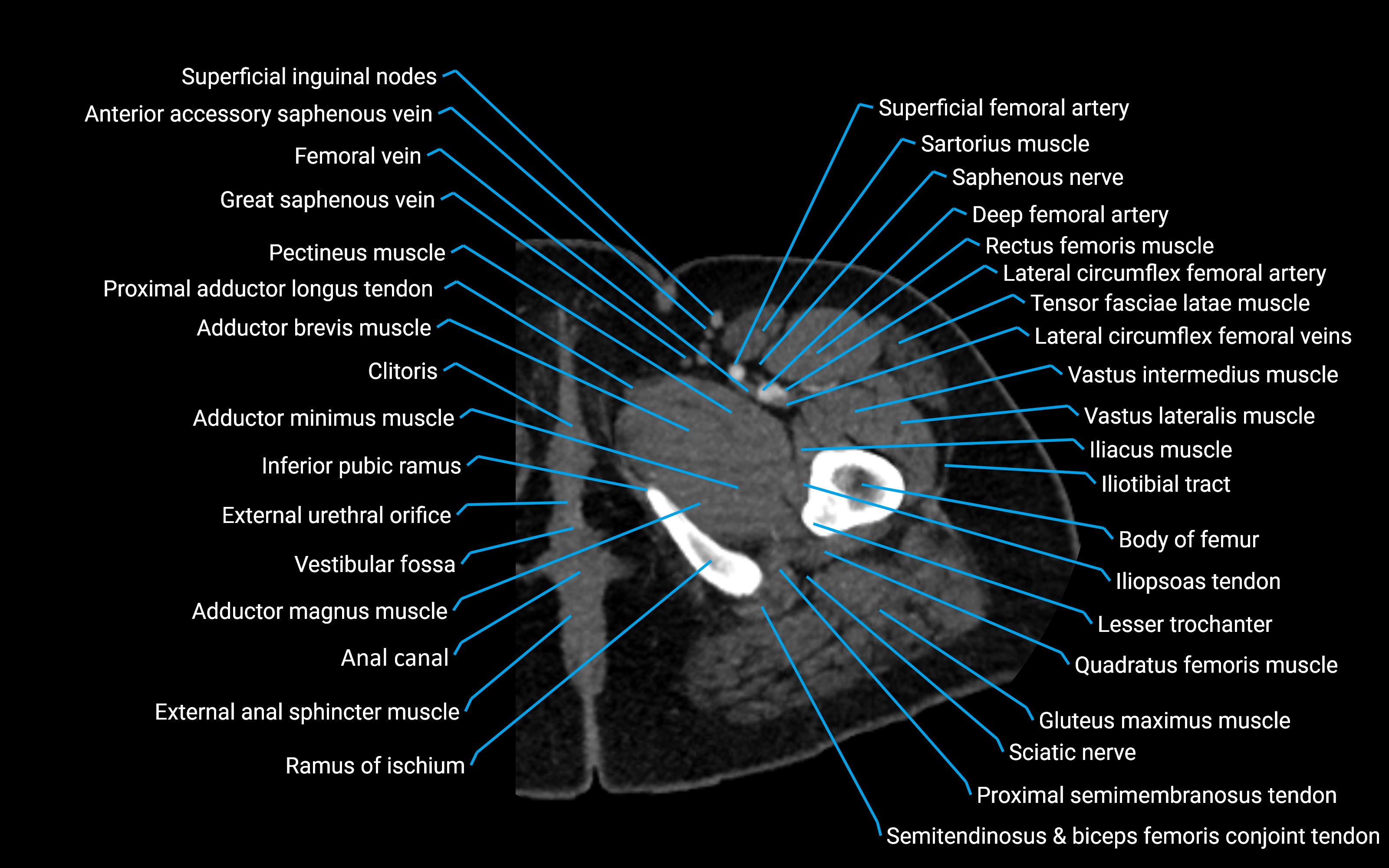 CT Hip axial cross sectional anatomy labelled image 18 (1).png